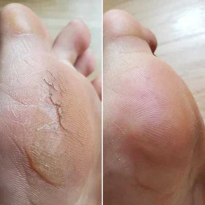 Electric Foot File for Soft Feet