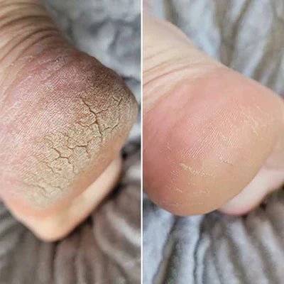 Electric Foot File for Soft Feet