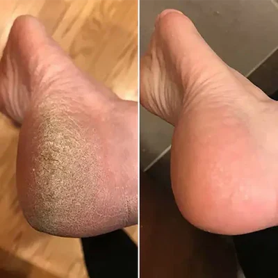 Electric Foot File for Soft Feet